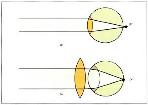 3. Irudia: (a) Begi hipermetrope baten kristalinoak izpi paraleloak fokatzen dituen modua dela-eta, irudia erretinaren atze aldean eratzen da. (b) Akats hori zuzentzeko, lente konbergente